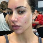 Psoriasis: la enfermedad del estrés y la ansiedad que padece Kim Kardashian