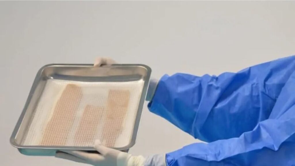 Banco de Tejidos del Edomex dona tejido amniótico para pacientes quemados en Iztapalapa