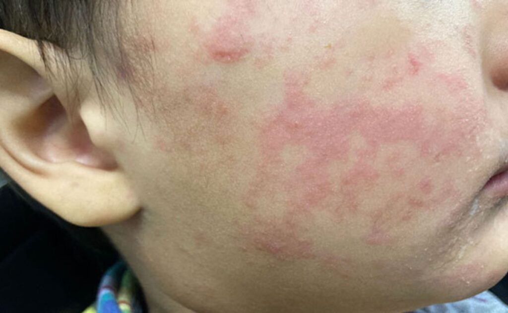 Casos de sarampión se extienden a 25 estados