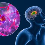 Investigadores ingleses desarrollan nueva inyección para la enfermedad de Huntington