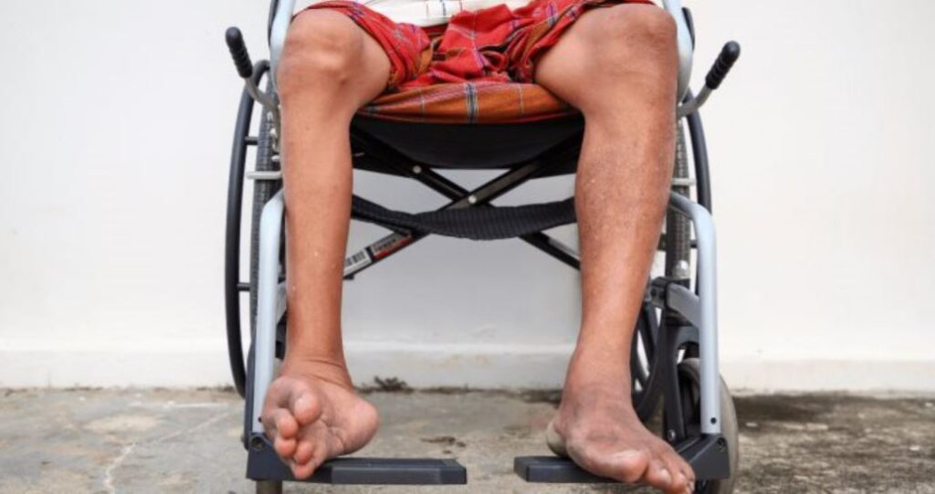 Poliomielitis, enfermedad viral que afecta nervios de médula ósea