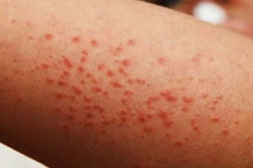 Morelos detecta 13 casos importados de sarampión; suman 5 mil a nivel nacional