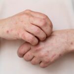 México registra el primer deceso por sarampión en 2026